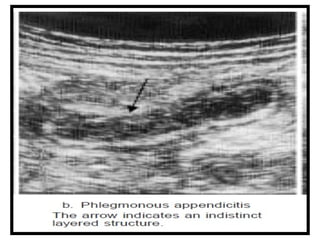 2. Acute appendicitis is the inflammation of vermiform appendix | PPTX