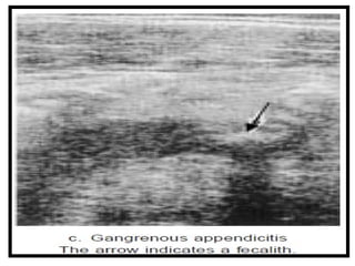2. Acute appendicitis is the inflammation of vermiform appendix | PPTX