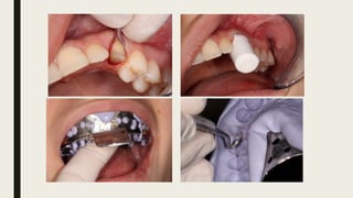 Retractiive Types Retraction, Retraksiyon, types of retraction | PPTX