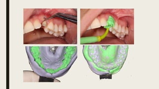Retractiive Types Retraction, Retraksiyon, types of retraction | PPTX