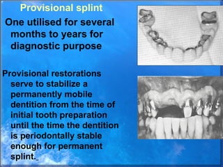 Permanent Splints 2._periodontal_splints.ppt,PERIODONTAL SPLINTS,PERIODNTAL PROSTHESIS | PPT
