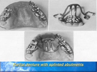 Permanent Splints 2._periodontal_splints.ppt,PERIODONTAL SPLINTS,PERIODNTAL PROSTHESIS | PPT