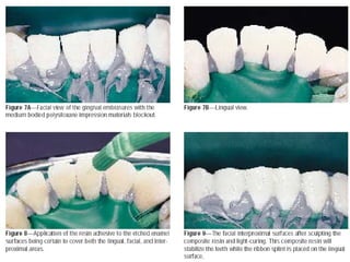 Permanent Splints 2._periodontal_splints.ppt,PERIODONTAL SPLINTS,PERIODNTAL PROSTHESIS | PPT