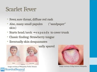 Sandpaper Rashes 2. Strep.pptxasdasdsdasdadadasdadasdasdadas | PPTX
