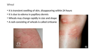 Wheal Rash Pattern 2. Terminology of skin lesions slide share.pptx