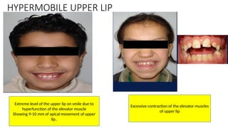 gummy smile CORRECTION ORTHODONTIST.pptx