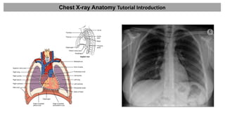 2. Chest X-ray Anatomy Tutorial Introduction.pdf