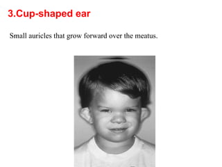 Ear Small Paragraph Comprehensive Overview of External Ear Anomalies and Injuries ...