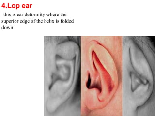 Comprehensive Overview of External Ear Anomalies and Injuries ...