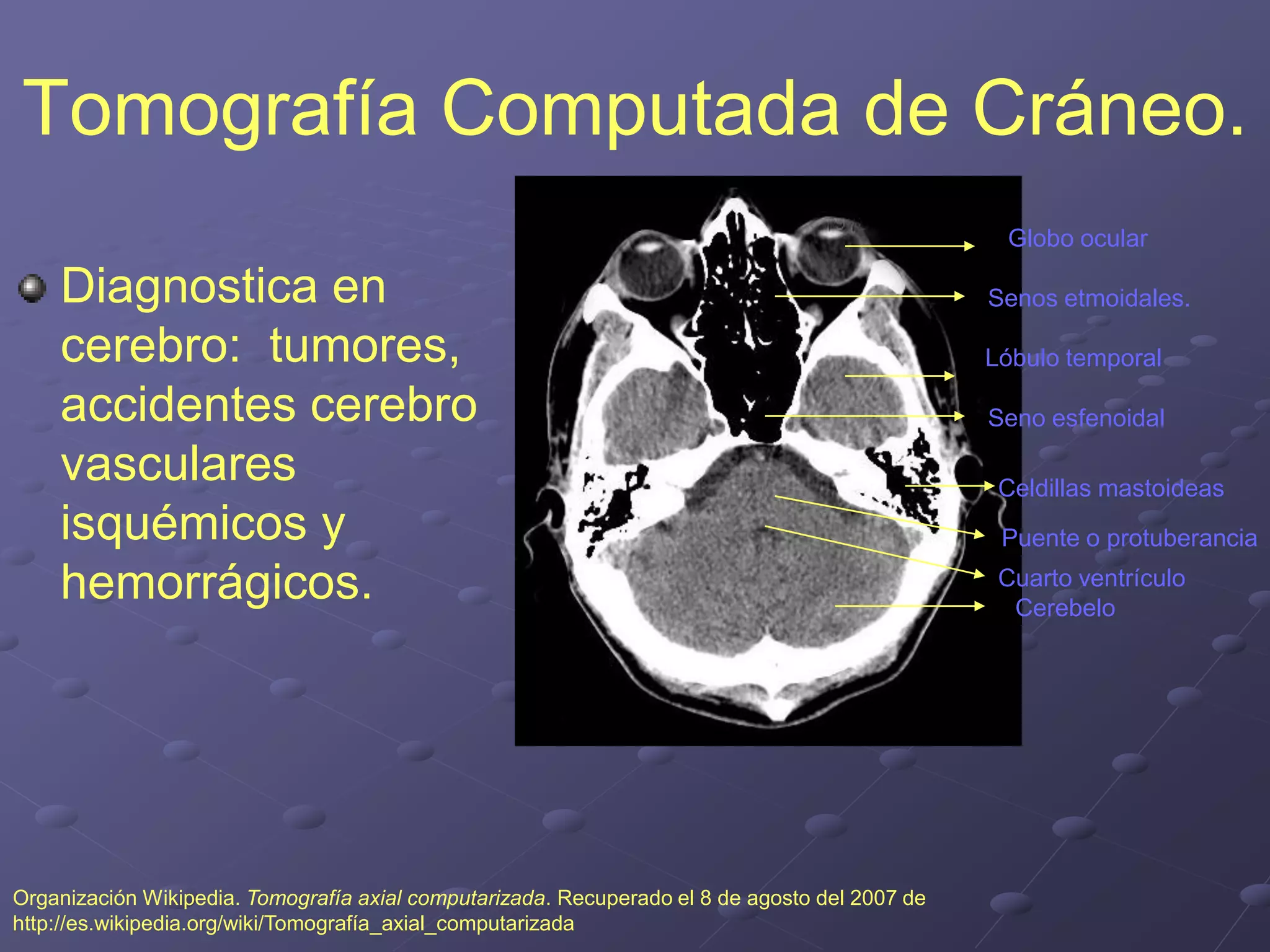 Tomografía Computada de Cráneo.
Diagnostica en
cerebro: tumores,
accidentes cerebro
vasculares
isquémicos y
hemorrágicos.
Organización Wikipedia. Tomografía axial computarizada. Recuperado el 8 de agosto del 2007 de
http://es.wikipedia.org/wiki/Tomografía_axial_computarizada
Globo ocular
Senos etmoidales.
Lóbulo temporal
Seno esfenoidal
Celdillas mastoideas
Puente o protuberancia
Cuarto ventrículo
Cerebelo
 