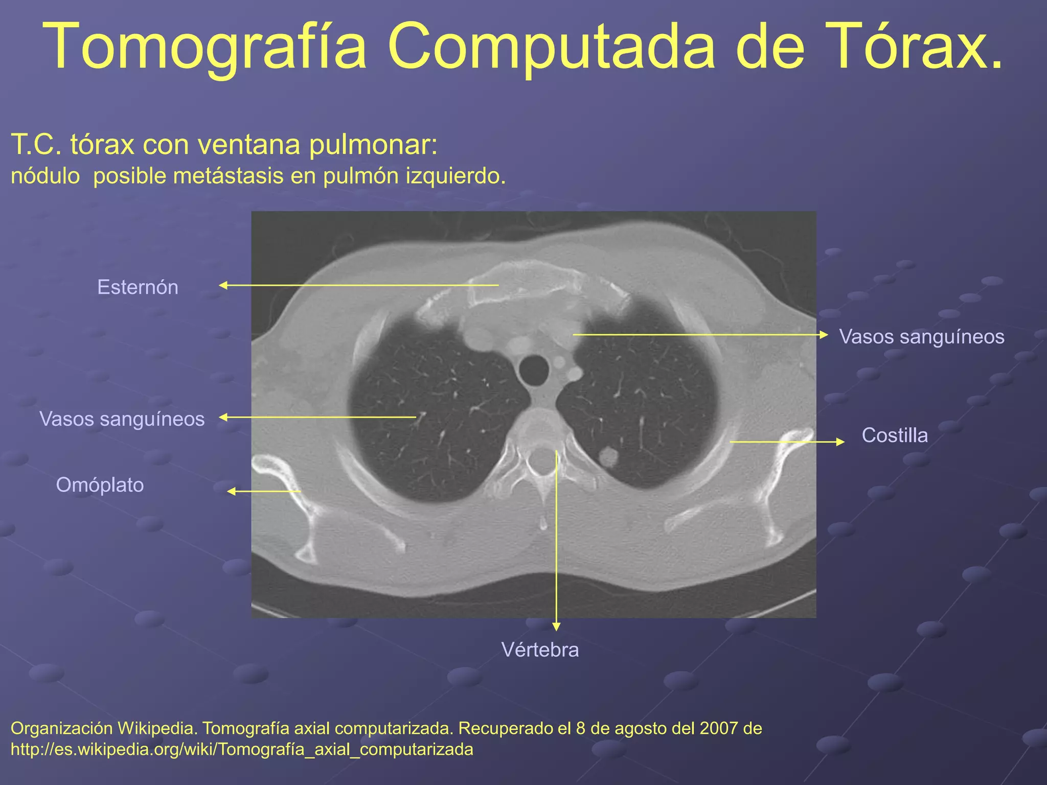 Tomografía Computada de Tórax.
Organización Wikipedia. Tomografía axial computarizada. Recuperado el 8 de agosto del 2007 de
http://es.wikipedia.org/wiki/Tomografía_axial_computarizada
T.C. tórax con ventana pulmonar:
nódulo posible metástasis en pulmón izquierdo.
Vasos sanguíneos
Esternón
Omóplato
Vértebra
Vasos sanguíneos
Costilla
 