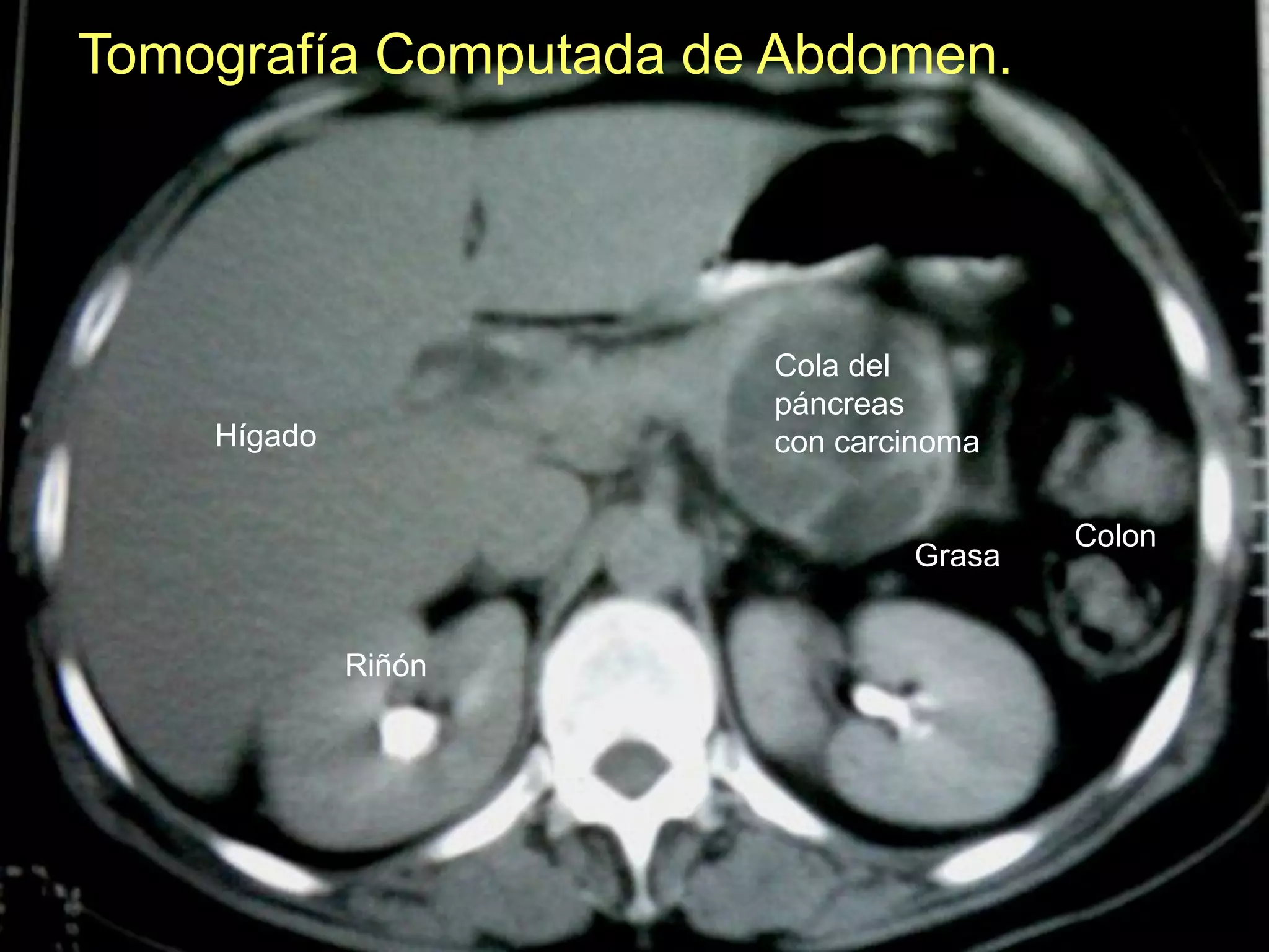 Tomografía Computada de Abdomen.
Hígado
Cola del
páncreas
con carcinoma
Riñón
Colon
Grasa
 