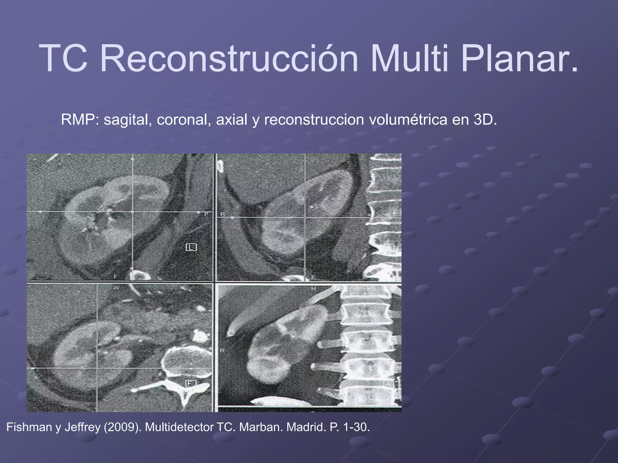 TC Reconstrucción Multi Planar.
RMP: sagital, coronal, axial y reconstruccion volumétrica en 3D.
Fishman y Jeffrey (2009). Multidetector TC. Marban. Madrid. P. 1-30.
 