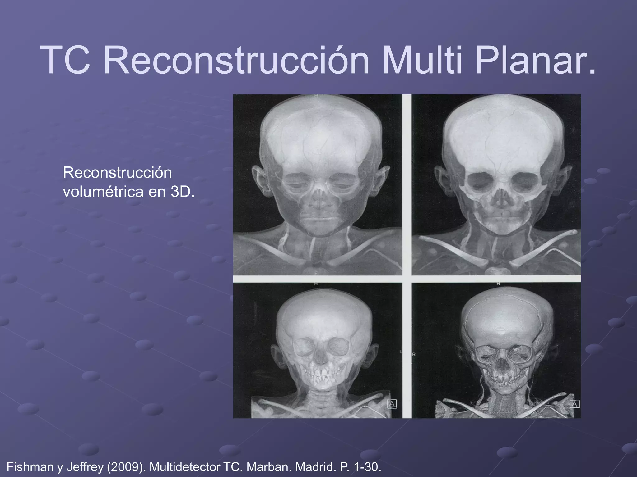 TC Reconstrucción Multi Planar.
Reconstrucción
volumétrica en 3D.
Fishman y Jeffrey (2009). Multidetector TC. Marban. Madrid. P. 1-30.
 