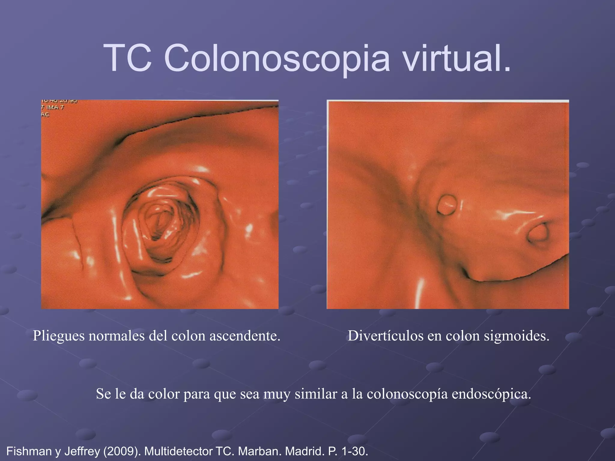 TC Colonoscopia virtual.
Se le da color para que sea muy similar a la colonoscopía endoscópica.
Pliegues normales del colon ascendente. Divertículos en colon sigmoides.
Fishman y Jeffrey (2009). Multidetector TC. Marban. Madrid. P. 1-30.
 