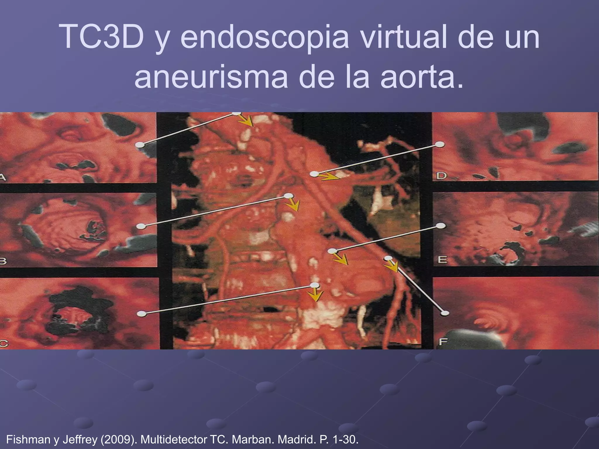 TC3D y endoscopia virtual de un
aneurisma de la aorta.
Fishman y Jeffrey (2009). Multidetector TC. Marban. Madrid. P. 1-30.
 