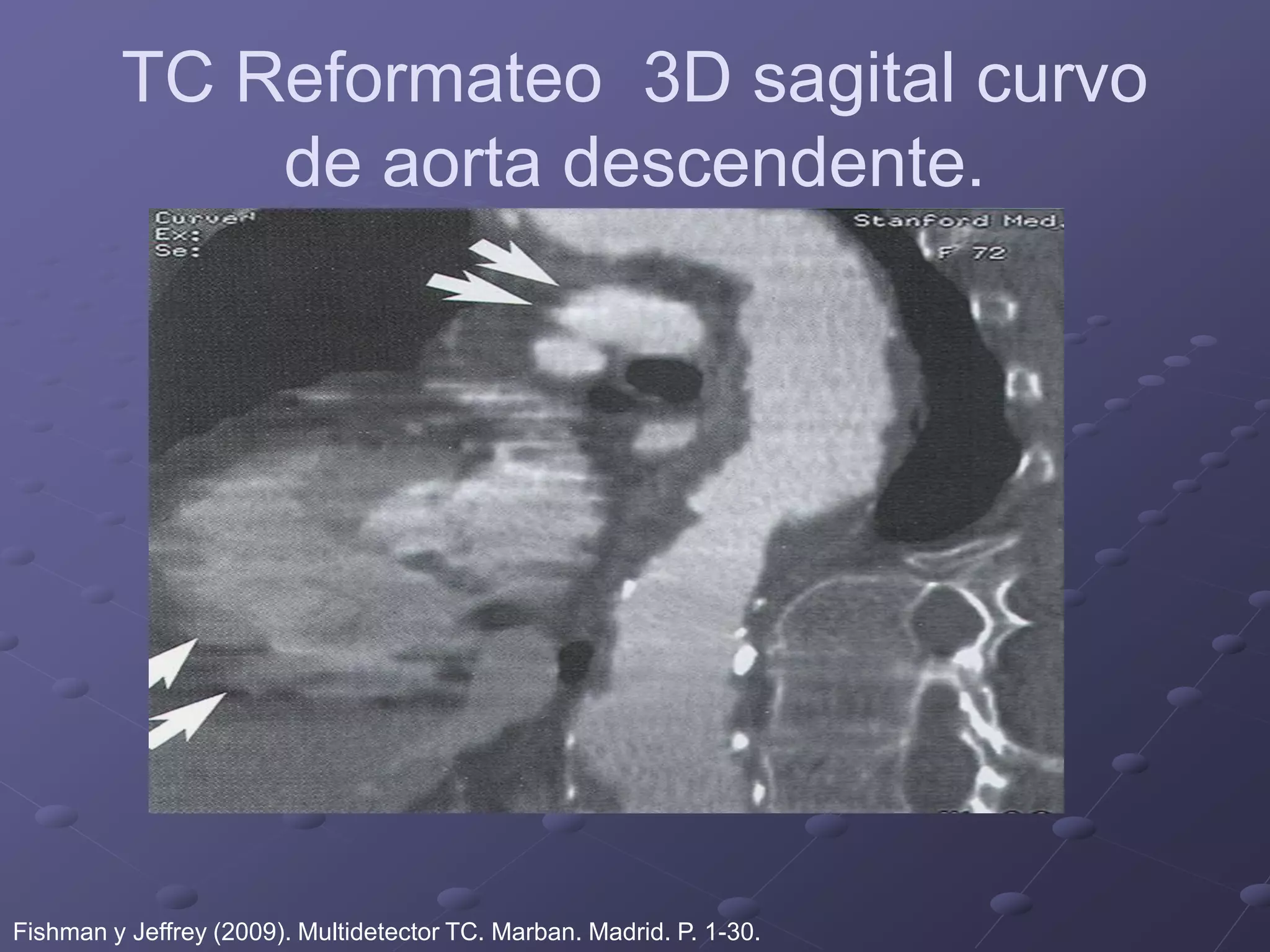 TC Reformateo 3D sagital curvo
de aorta descendente.
Fishman y Jeffrey (2009). Multidetector TC. Marban. Madrid. P. 1-30.
 