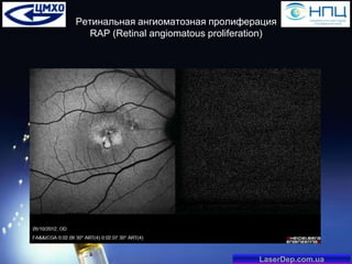 Ретинальная ангиоматозная пролиферация
RAP (Retinal angiomatous proliferation)

LaserDep.com.ua

 