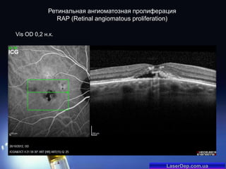 Ретинальная ангиоматозная пролиферация
RAP (Retinal angiomatous proliferation)
Vis OD 0,2 н.к.
ICG

LaserDep.com.ua

 