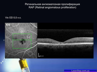 Ретинальная ангиоматозная пролиферация
RAP (Retinal angiomatous proliferation)

Vis OD 0,5 н.к.

ICG

LaserDep.com.ua

 