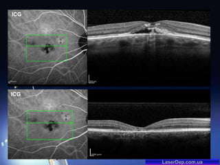 ICG

ICG

LaserDep.com.ua

 