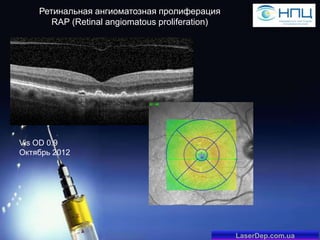 Ретинальная ангиоматозная пролиферация
RAP (Retinal angiomatous proliferation)

Vis OD 0.9
Октябрь 2012

LaserDep.com.ua

 
