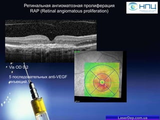 Ретинальная ангиоматозная пролиферация
RAP (Retinal angiomatous proliferation)

Vis OD 0,2
5 последовательных anti-VEGF
инъекций.

LaserDep.com.ua

 