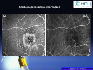 Комбинированная ангиография

FA

ICG

LaserDep.com.ua

 