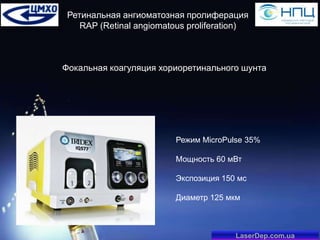 Ретинальная ангиоматозная пролиферация
RAP (Retinal angiomatous proliferation)

Фокальная коагуляция хориоретинального шунта

Режим MicroPulse 35%

Мощность 60 мВт
Экспозиция 150 мс
Диаметр 125 мкм

LaserDep.com.ua

 