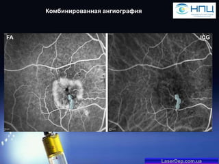 Комбинированная ангиография

FA

ICG

LaserDep.com.ua

 