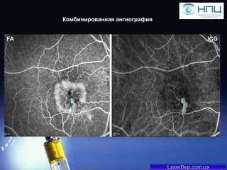 Комбинированная ангиография
FA

ICG

LaserDep.com.ua

 
