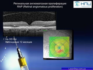 Ретинальная ангиоматозная пролиферация
RAP (Retinal angiomatous proliferation)

Vis OD 0,4
Наблюдение 12 месяцев

LaserDep.com.ua

 
