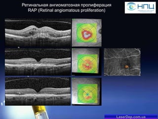Ретинальная ангиоматозная пролиферация
RAP (Retinal angiomatous proliferation)

LaserDep.com.ua

 