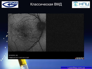 Классическая ВМД

LaserDep.com.ua

 