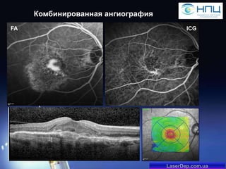 Комбинированная ангиография
FA

ICG

LaserDep.com.ua

 