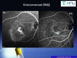Классическая ВМД
FA

ICG

LaserDep.com.ua

 