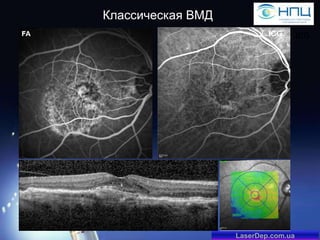 Классическая ВМД
ICG

LaserDep.com.ua

ICG

 