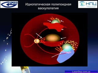 Идиопатическая полипоидная
васкулопатия

LaserDep.com.ua

 