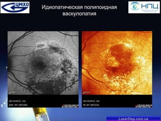 Идиопатическая полипоидная
васкулопатия

LaserDep.com.ua

 