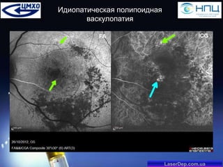 Идиопатическая полипоидная
васкулопатия
FA

ICG

LaserDep.com.ua

 