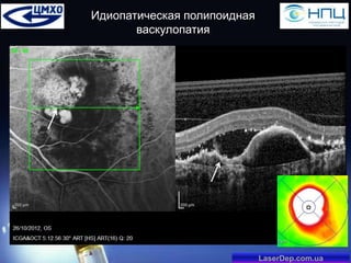 Идиопатическая полипоидная
васкулопатия

LaserDep.com.ua

 