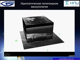 Идиопатическая полипоидная
васкулопатия

LaserDep.com.ua

 