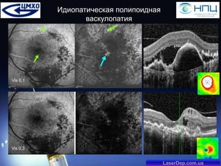 Идиопатическая полипоидная
васкулопатия

Vis 0,1

Vis 0,3

LaserDep.com.ua

 
