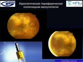 Идиопатическая переферическая
полипоидная васкулопатия

LaserDep.com.ua

 