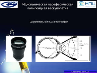 Идиопатическая переферическая
полипоидная васкулопатия

Широкопольная ICG ангиография

LaserDep.com.ua

 