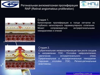 Ретинальная ангиоматозная пролиферация
RAP (Retinal angiomatous proliferation)

Стадия 1.
Капиллярная пролиферация в толще сетчатки из
глубокого капиллярного парамакулярного сплетения.
Может
сопровождаться
интраретинальными
геморрагиями и отеком

Стадия 2.
Субретинальная неоваскуляризация при росте сосудов
в направлении ПЭС. Отслойка нейроэпителеия,
увеличение
интраретинального
отека.
Преретинальные и интраретинальные геморрагии.
Серозная
отслойка
ПЭС.
Ретино-ретинальные
анастомозы.

LaserDep.com.ua

 