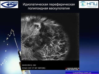 Идиопатическая переферическая
полипоидная васкулопатия

LaserDep.com.ua

 