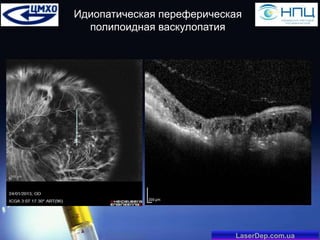 Идиопатическая переферическая
полипоидная васкулопатия

LaserDep.com.ua

 