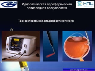 Идиопатическая переферическая
полипоидная васкулопатия

Транссклеральная диодная ретинопексия

LaserDep.com.ua

 