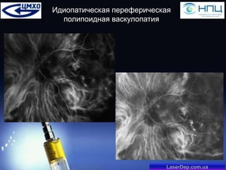 Идиопатическая переферическая
полипоидная васкулопатия

LaserDep.com.ua

 